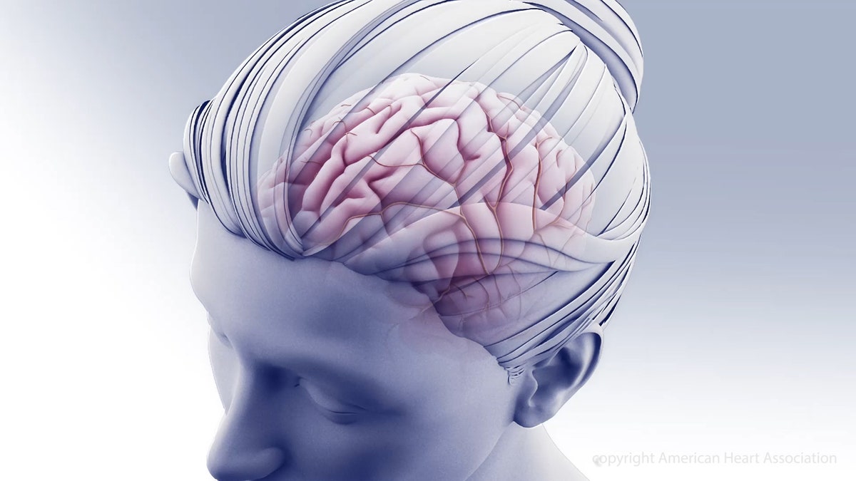 People with brain aneurysms at higher risk of some mental health disorders, study finds