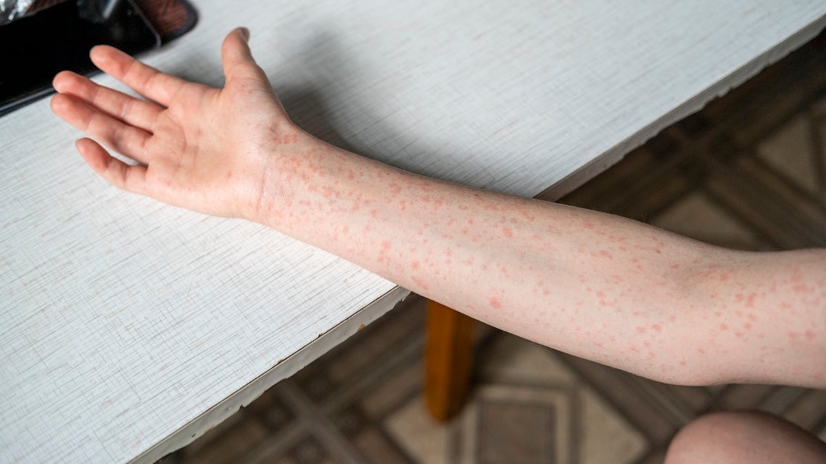 Officials in West Coast state sound alarm after traveler diagnosed with highly contagious viral disease