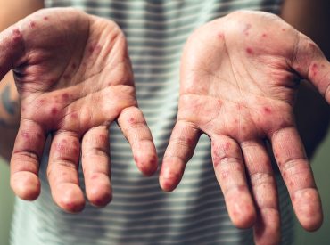 Highly contagious disease surges in some US states amid report of possible fatal case