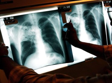 Three active tuberculosis cases reported in Maine as deadly disease continues to tick up across country