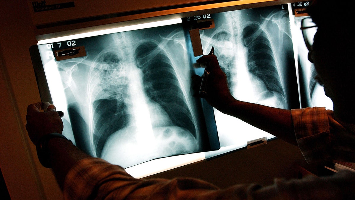 X-rays of TB patient
