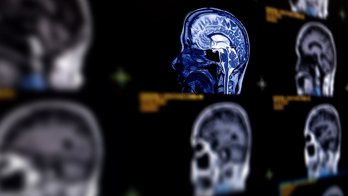 MRI brain scan showing multiple skulls