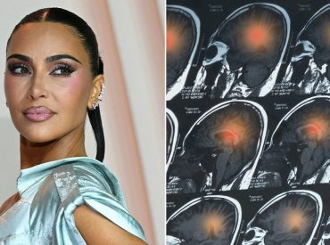 Kim Kardashian’s brain aneurysm scare: Doctors reveal warning signs to never ignore