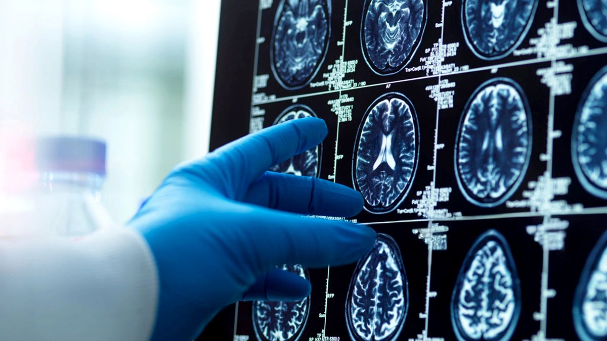 Men's brains shrink faster than women's; researchers explore Alzheimer's connection