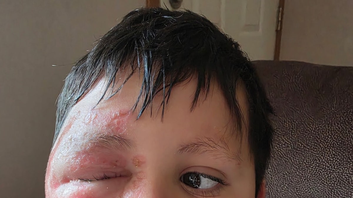 Caleb Chabolla burned face from NeeDoh