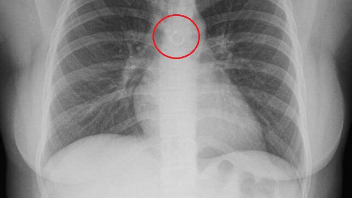 X-ray image showing a metallic object lodged in Monica Deyanira Cabrera Barajas's lung