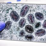 First clade I mpox case confirmed in Connecticut after patient traveled to Western Europe