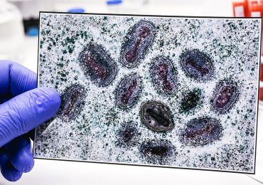 First clade I mpox case confirmed in Connecticut after patient traveled to Western Europe