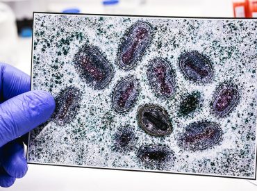 First clade I mpox case confirmed in Connecticut after patient traveled to Western Europe