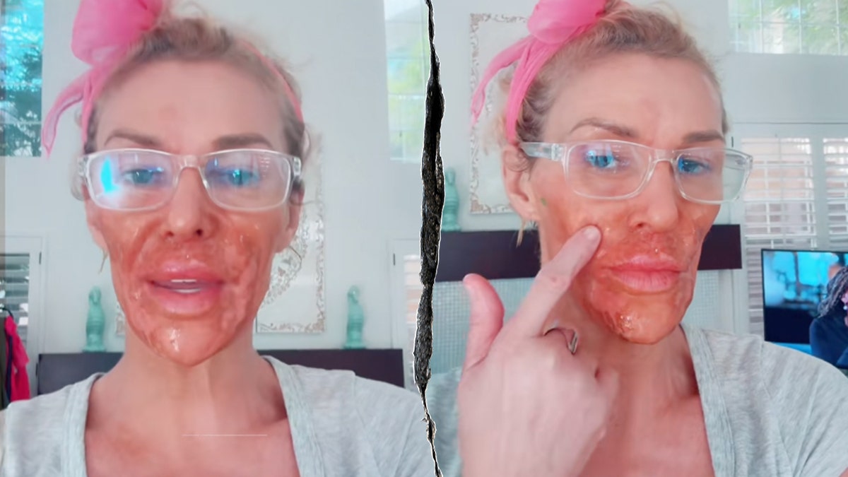 Brandi Glanville showing facial burns in a close-up selfie.