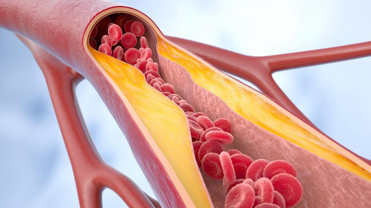 Cholesterol in arteries