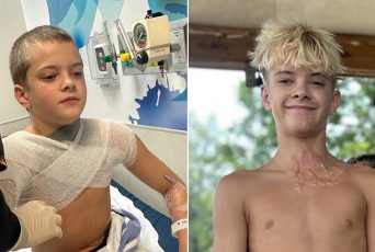 Microwaved squishy toy explodes onto boy’s face and chest amid viral trend, causing horrific burns