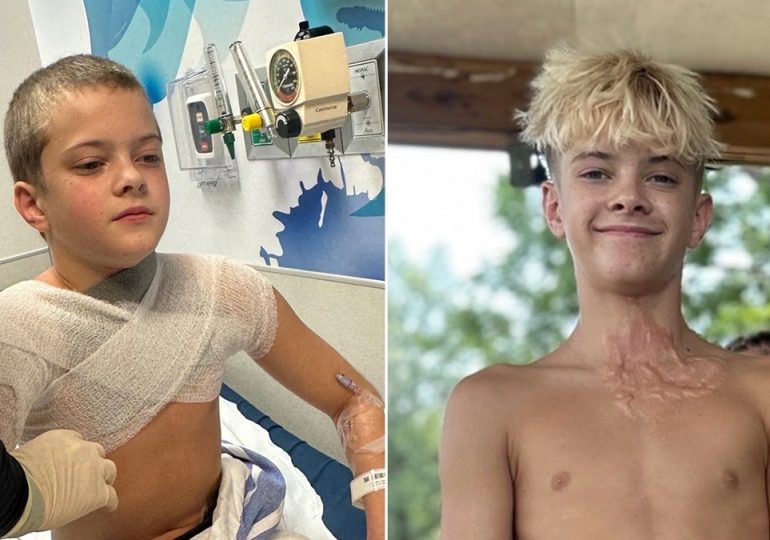Microwaved squishy toy explodes onto boy's face and chest amid viral trend, causing horrific burns