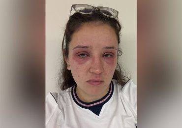 Bride cautions others before wedding day about risky beauty treatments: 'Pain wasn't worth it'