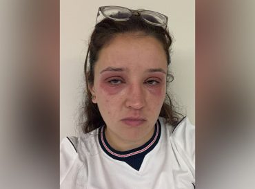 Bride cautions others before wedding day about risky beauty treatments: 'Pain wasn't worth it'