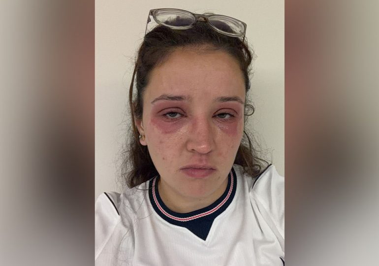 Bride cautions others before wedding day about risky beauty treatments: 'Pain wasn't worth it'